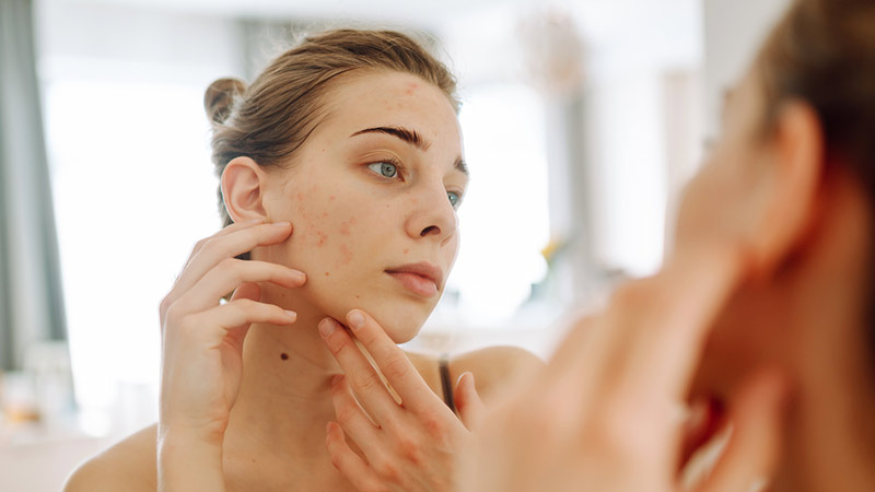 Hoe nuttig zijn acne patches? 